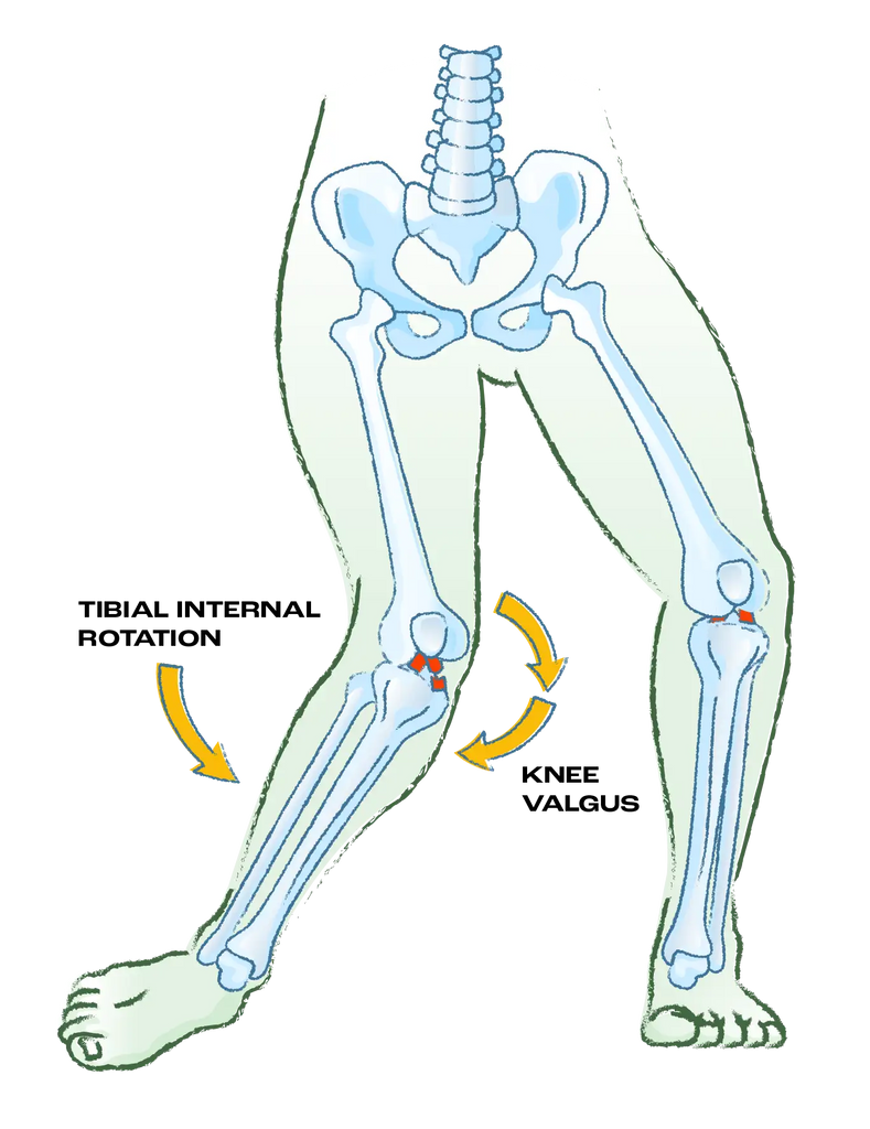 How Footwear Affects Knee Injuries | The Impact of Foot Alignment ...